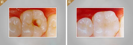 补一颗牙多少钱？