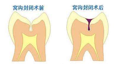儿童窝沟封闭要不要做？
