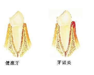 患有牙龈炎时能洗牙吗？