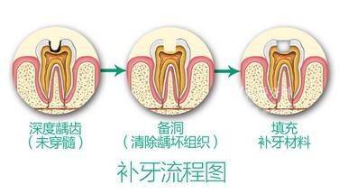 口腔医院补牙要多久？