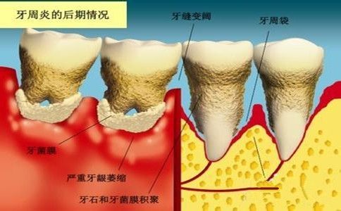 牙周炎需要拔牙吗？