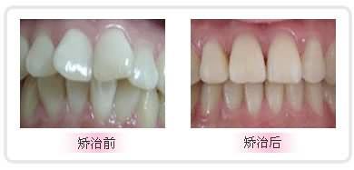 矫正龅牙费用一般需要多少？