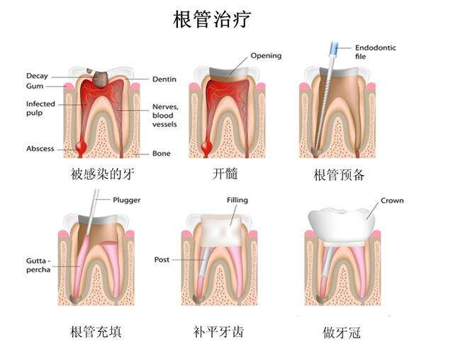 牙髓炎怎么办？有哪些治疗方法？