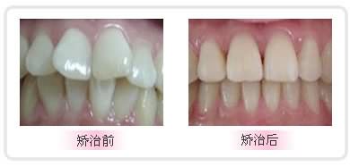 矫正龅牙一般需要多少钱？