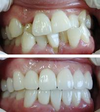 牙齿拥挤矫正过程是怎样的？