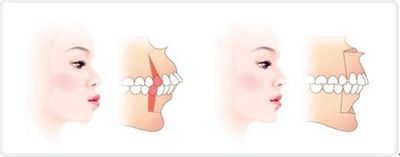 牙齿骨性前突怎么办？