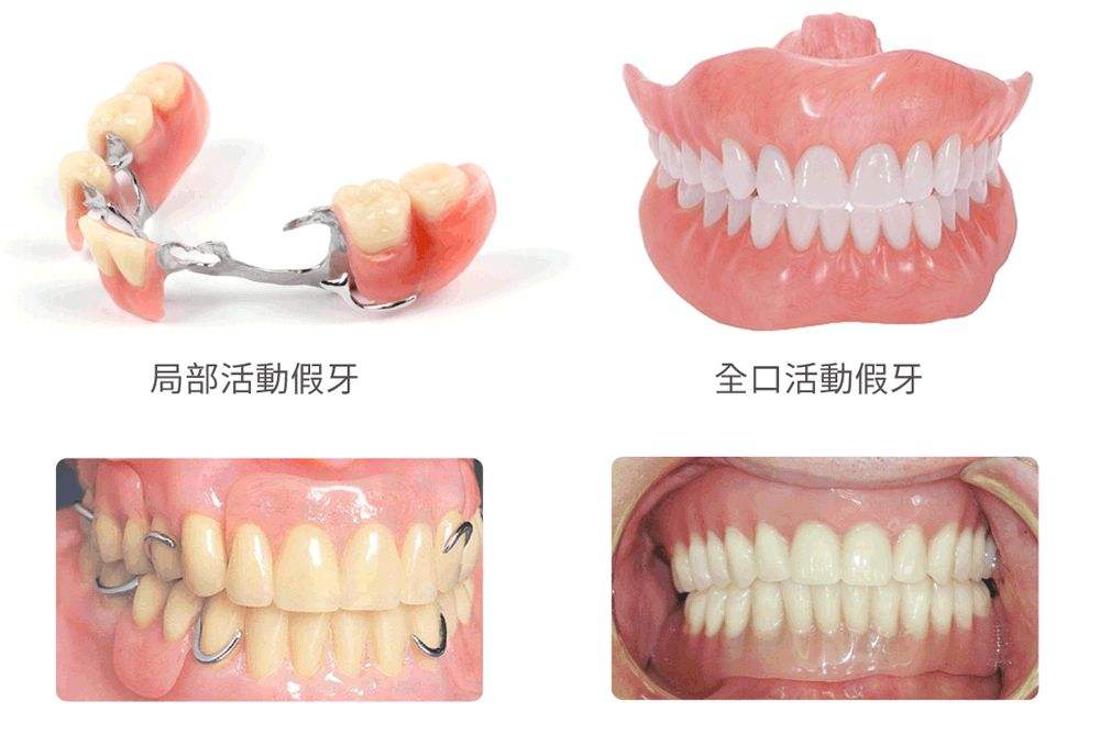 活动假牙种类