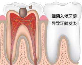 牙髓炎是由什么原因造成的？
