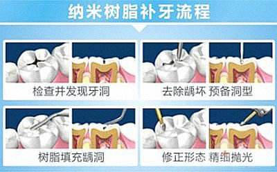 专业补牙过程是怎样的? 专业补牙过程是怎样的?