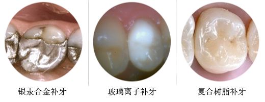 专业补牙过程是怎样的? 专业补牙过程是怎样的?