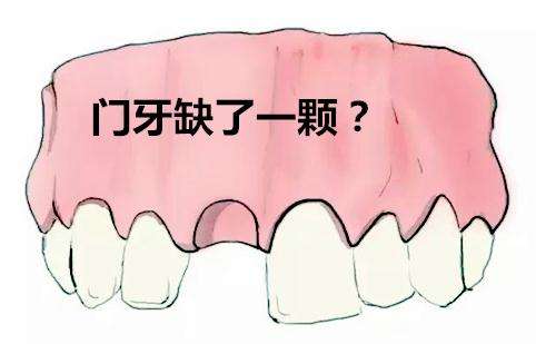 镶门牙选择哪种材料比较好? 镶门牙选择哪种材料比较好?