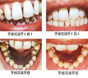 洗牙美白需要多少钱? 洗牙美白需要多少钱?