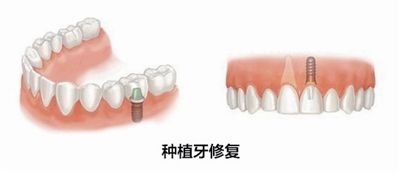 深圳镶牙一般需要多少钱? 深圳镶牙一般需要多少钱?