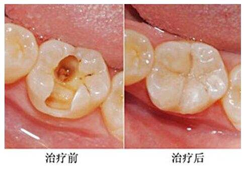 补牙都有什么材料?哪种比较好? 补牙都有什么材料?哪种比较好?