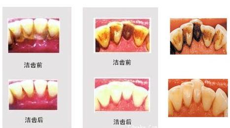 洗牙得多少钱? 洗牙得多少钱?