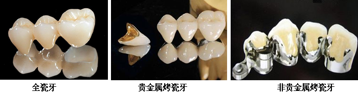 门牙烤瓷牙一般需要多少钱? 门牙烤瓷牙一般需要多少钱?