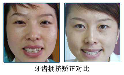 牙齿拥挤不齐矫治费用一般是多少? 牙齿拥挤不齐矫治费用一般是多少?