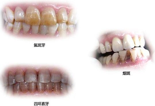 牙齿变色了是怎么回事? 牙齿变色了是怎么回事?