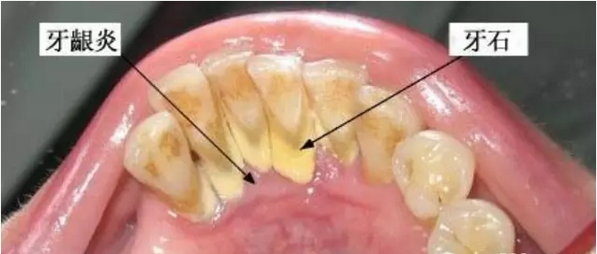 左氧氟沙星可以治疗牙龈炎吗? 左氧氟沙星可以治疗牙龈炎吗?