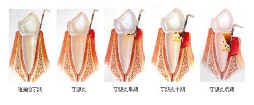 重度牙龈炎的症状有哪些？