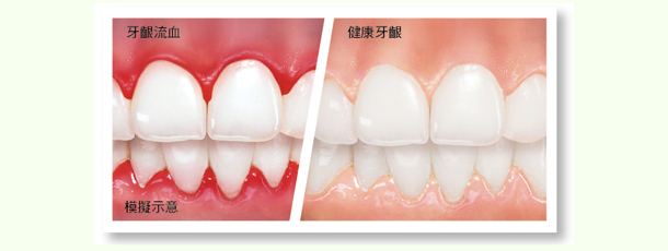增生性牙龈炎的症状有哪些? 增生性牙龈炎的症状有哪些?