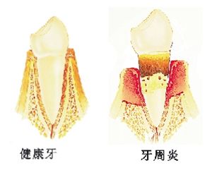 牙周炎与牙龈炎的区别有哪些？