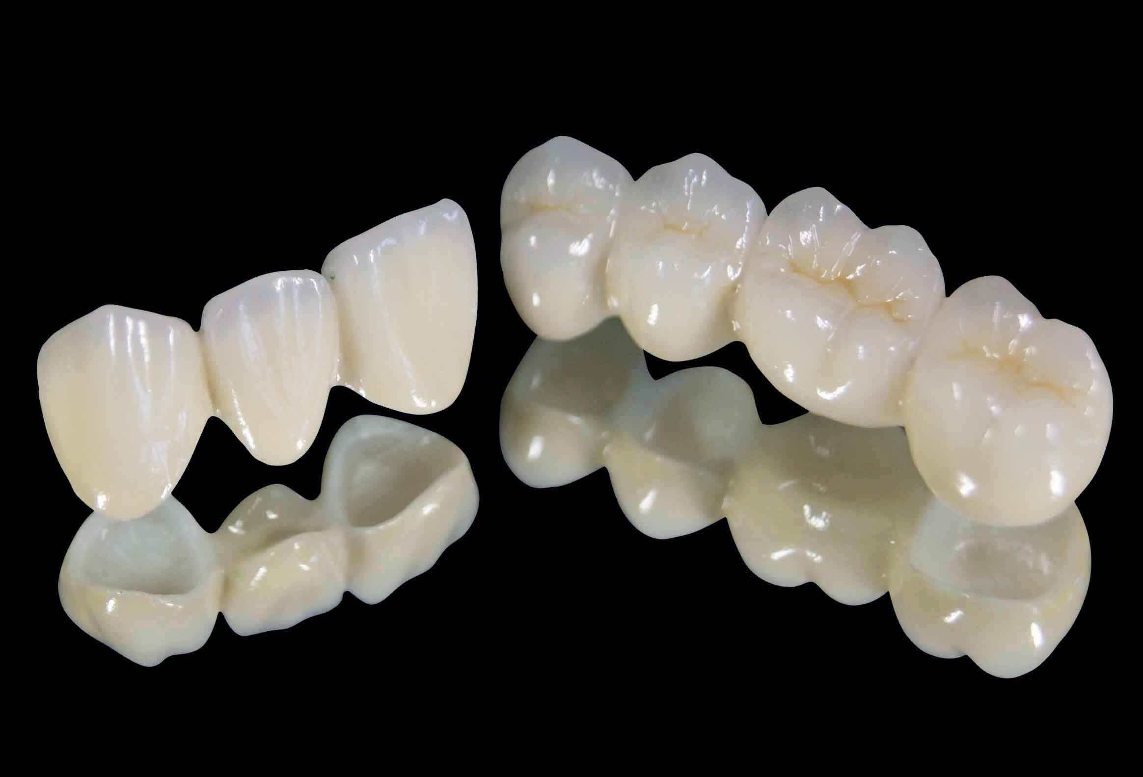 全烤瓷牙多少钱一颗? 全烤瓷牙多少钱一颗?