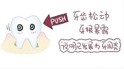 牙齿松动是牙龈炎吗? 牙齿松动是牙龈炎吗?