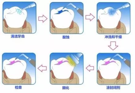 什么是窝沟封闭？