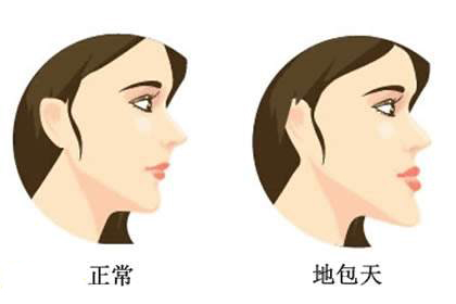 18岁地包天能矫正牙齿吗? 18岁地包天能矫正牙齿吗?