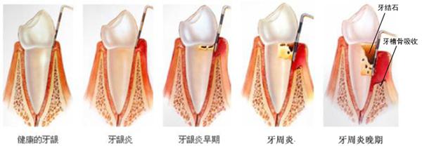 怎么治疗牙龈炎? 怎么治疗牙龈炎?