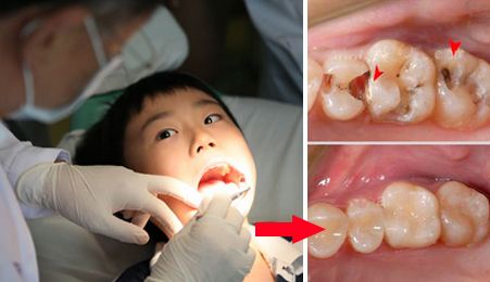 儿童治疗龋齿要多少钱？