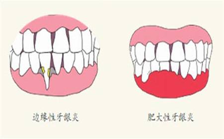 孕期牙龈炎怎么治疗？