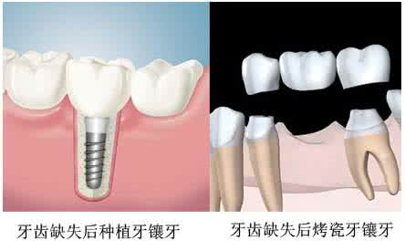 镶牙的材料有哪些? 镶牙的材料有哪些?
