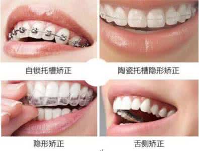 牙齿矫正多少钱啊? 牙齿矫正多少钱啊?