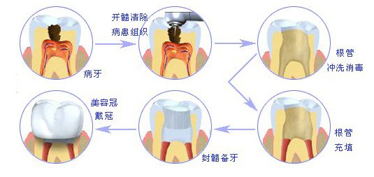 根管治疗收费标准是怎样的? 根管治疗收费标准是怎样的?