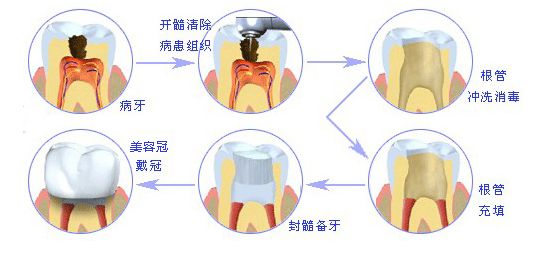 根管治疗收费标准是怎样的？