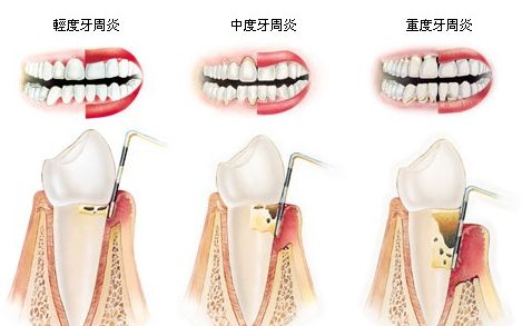 牙周炎症状怎么治疗? 牙周炎症状怎么治疗?