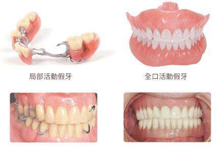 镶活动假牙多少钱? 镶活动假牙多少钱?