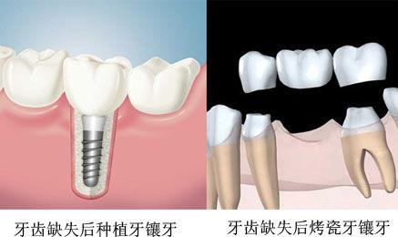 镶固定牙需要多少钱？