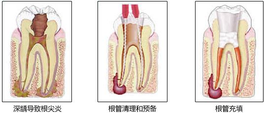 深圳牙齿根管治疗费用是多少? 深圳牙齿根管治疗费用是多少?
