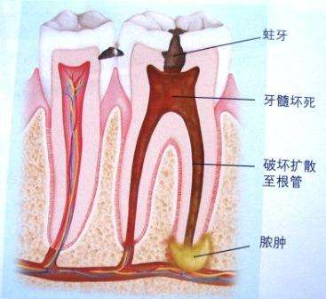 深圳牙齿根管治疗费用是多少? 深圳牙齿根管治疗费用是多少?