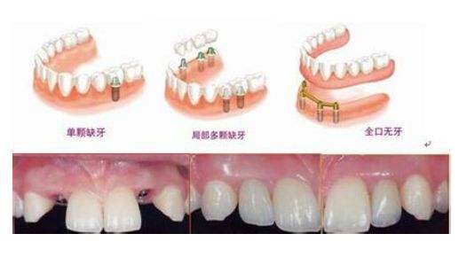 牙齿没了怎么修复比较好？