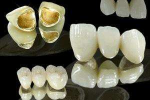 黄金烤瓷牙一般能使用多长时间? 黄金烤瓷牙一般能使用多长时间?