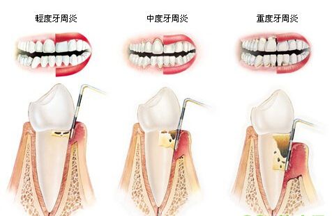 严重的牙周炎怎么办? 严重的牙周炎怎么办?