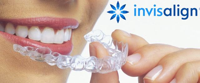 invisalign多少钱?价格贵不贵? invisalign多少钱?价格贵不贵?