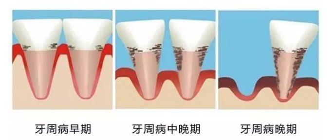 牙周炎是怎么回事? 牙周炎是怎么回事?