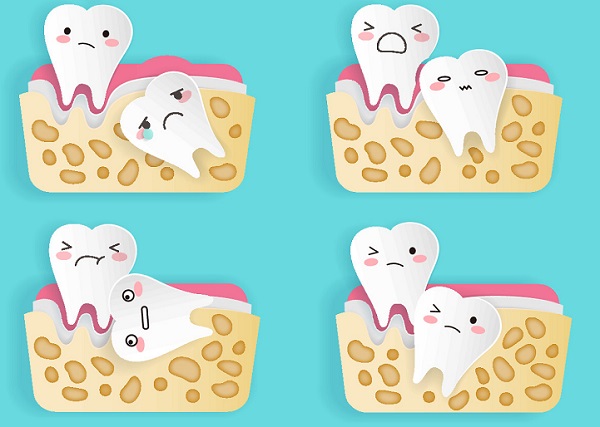 深圳拔智齒多少錢一顆