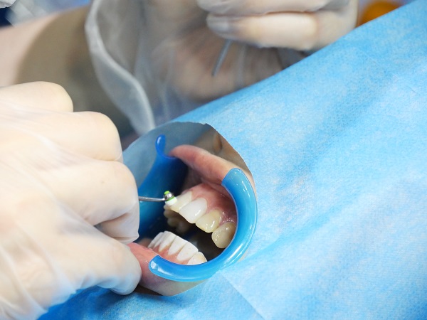 洗牙抛光和不抛光区别大吗