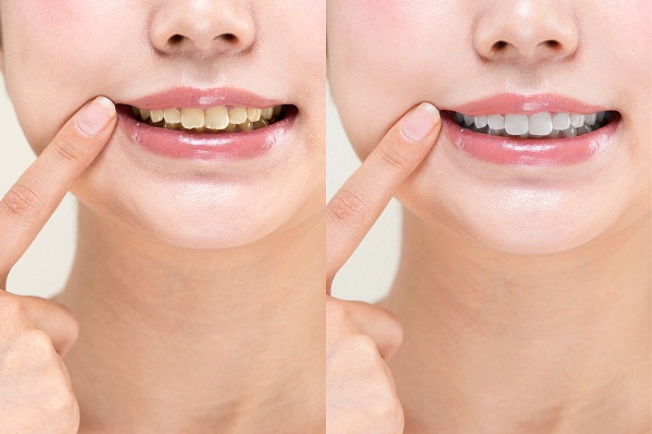 洗牙和牙齿美白有什么区别